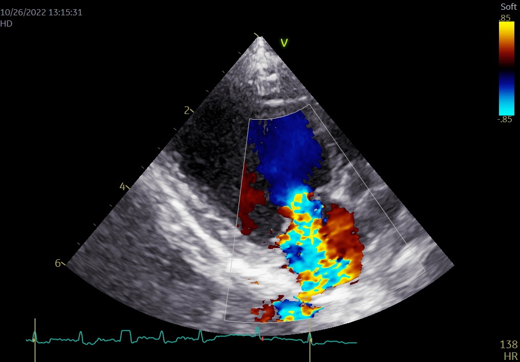 カラードプラによる僧帽弁逆流の確認