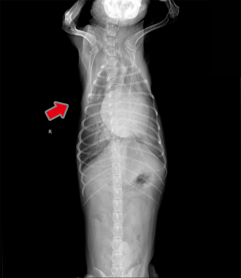 肺水腫(治療       前)